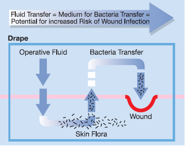 A sterile drape should be waterproof and impervious to strikethrough. A drape that allows fluid transfer, and thus bacteria transfer, compromises the sterile field, which increases the risk of wound infection. That is why a drape that is impervious to liquid strikethrough is so important.